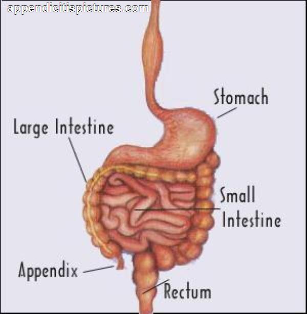 Chronic Appendicitis Symptoms, Causes And Treatments