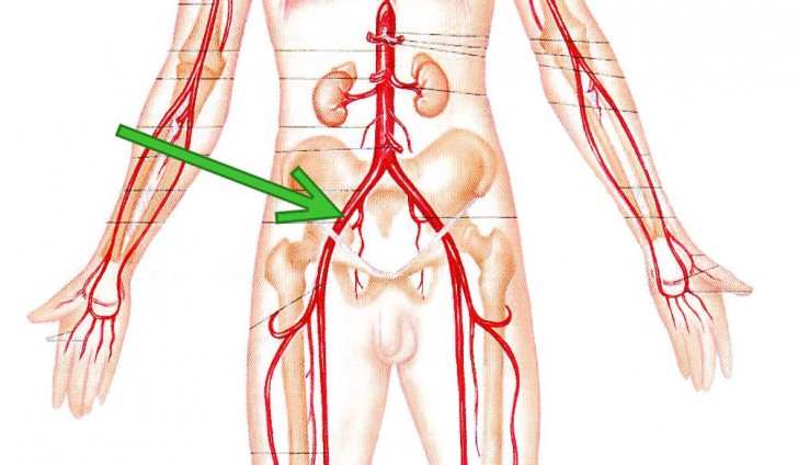 femoral artery bleed out