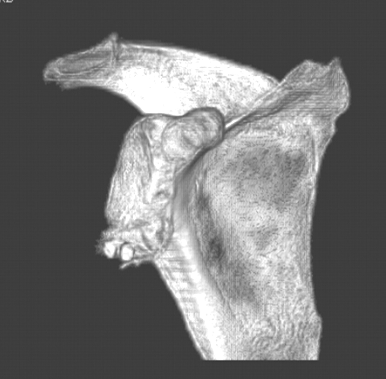 iliac crest bone graft technique - ModernHeal.com