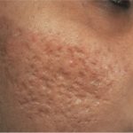 Boxcar acne scars