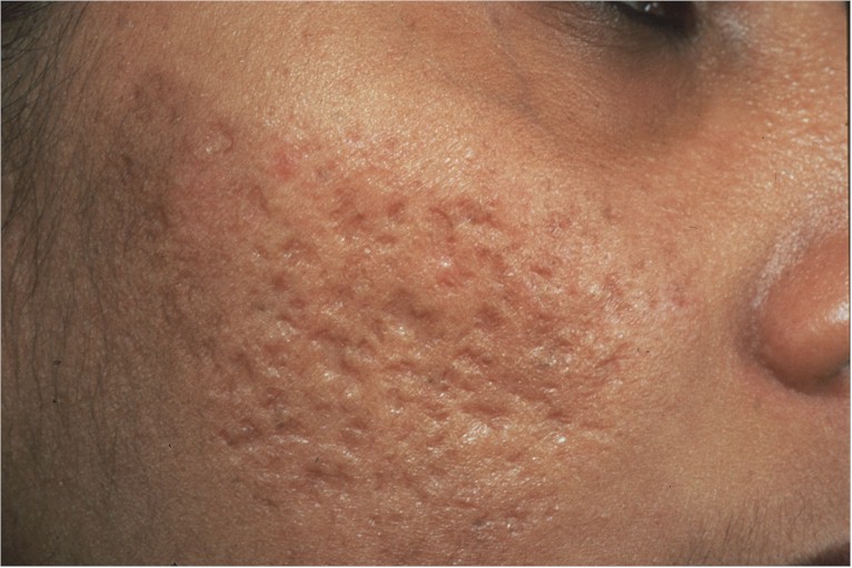 Boxcar acne scars