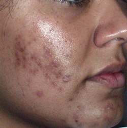 Keloid acne scars
