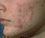 Acne scars