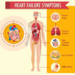 Heart failure symptoms