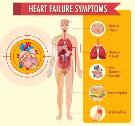 Heart failure symptoms