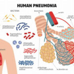 Is Pneumonia Contagious?