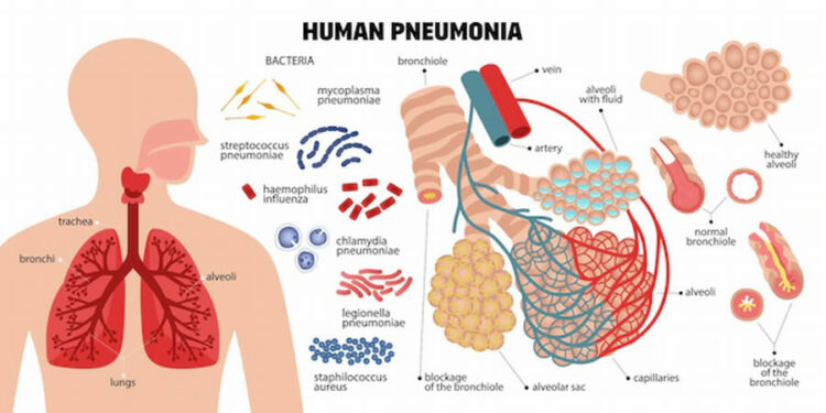 Pneumonia